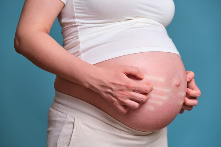 Zwangerschapsjeuk oorzaken en oplossingen