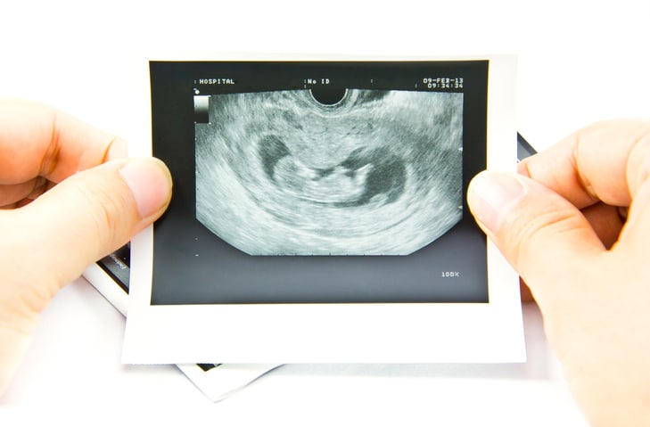 3 maanden zwanger je baby zien tijdens de termijn echo