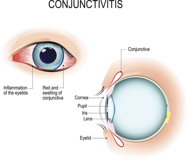 Conjunctivitis externe weergave en verticale sectie van de menselijke ogen