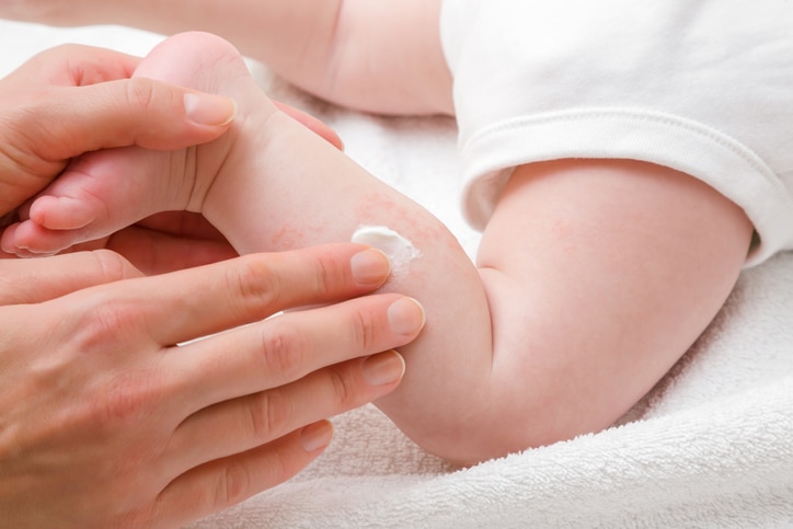Hoe kan je huiduitslag of eczeem bij een baby voorkomen