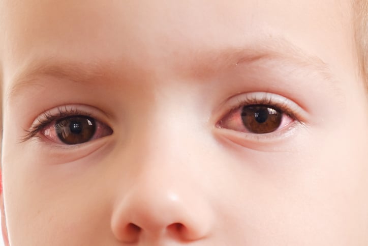 conjunctivitis rode ogen met infectie ontstoken ogen