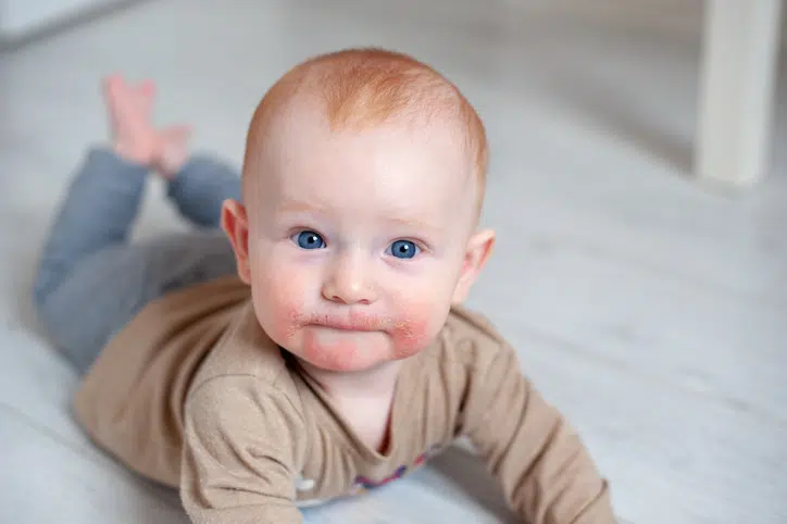 eczeem huiduitslag bij je baby