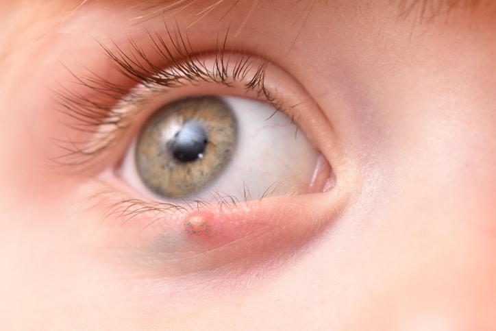 ontstoken ogen strontje en talgklierzwelling
