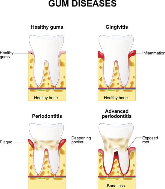 bloedend tandvlees gingivitis en parodontitis