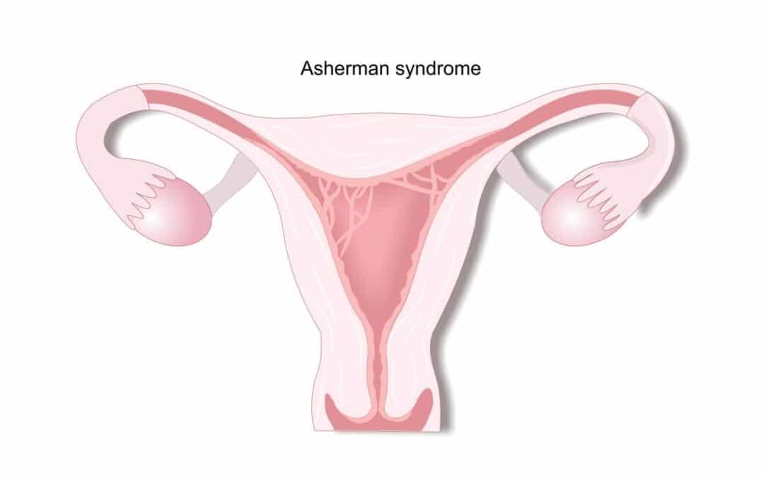 Asherman syndroom: Van oorzaak tot behandeling.