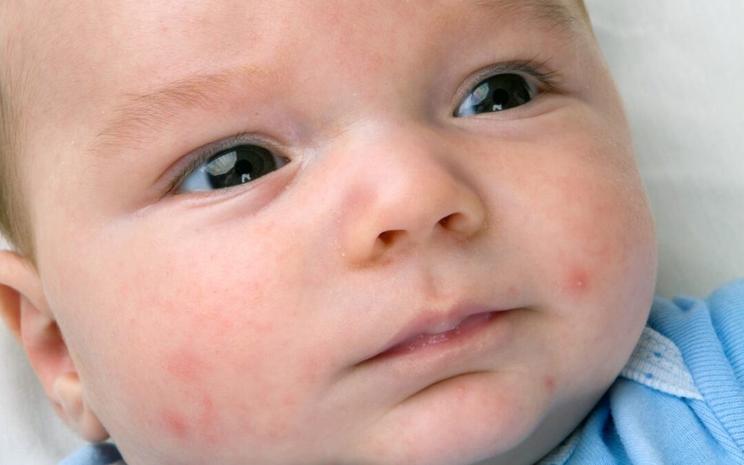 Baby acne: Wat is het en wat kun je er aan doen?