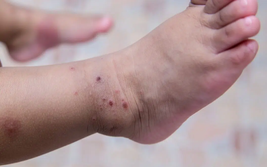Mijn kind heeft hand,- voet- en mondziekte: wat nu?