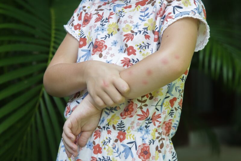 Kind met muggenbulten